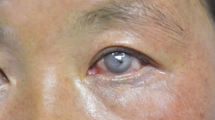 眼角膜移植需要哪些條件?